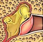 Острый средний отит Острый средний отит