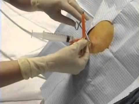 Что такое плевральной форме развития пневмонии