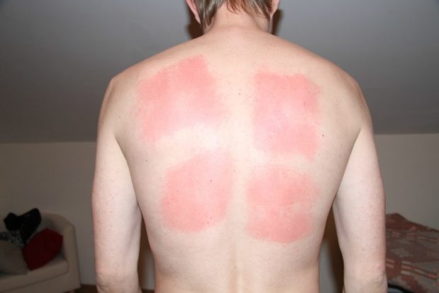 Ожог от горчичников 1 степени на спине