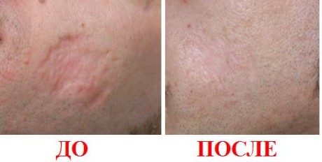 Эффект от применения препарата Эффект от применения препарата