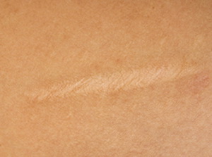 Нормотрофический рубец после ожога