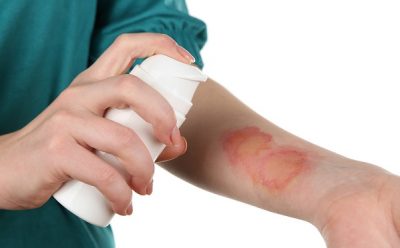 Как лечить ожог если появился волдырь