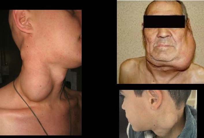 Клебсиелла пневмонии зева, исследуй мазок!