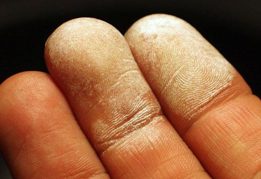 Ожог пальцев на руке