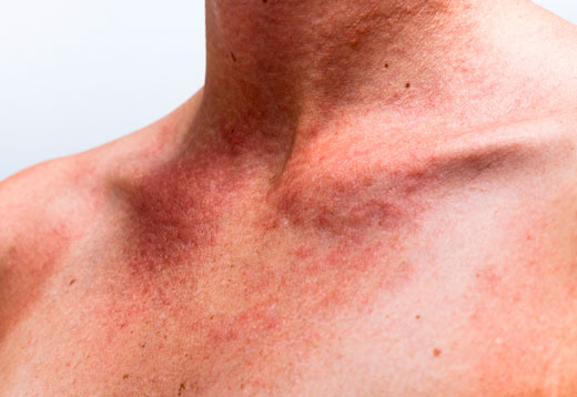 ожог на коже у мужчины