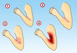 osnovy-okazaniya-pervoj-pomoshchi-pri-ozhogakh
