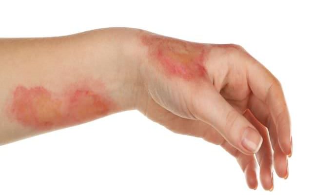 Чем мазать гнойную рану после ожога