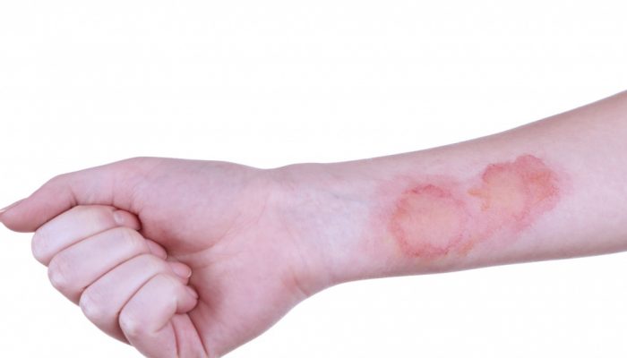 Чем мазать гнойную рану после ожога