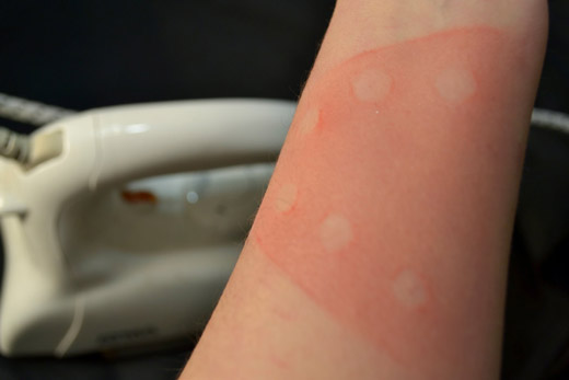 ожог от утюга на руке