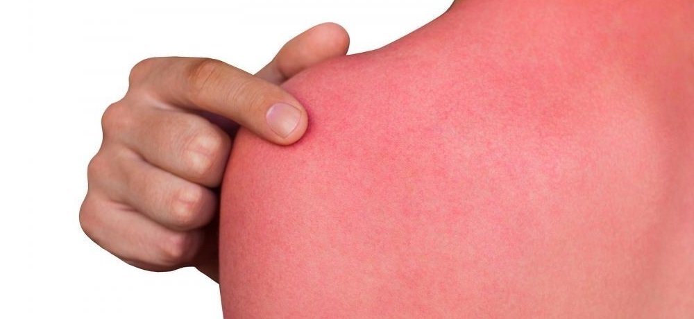 Ожог Ожог слизистой после лучевой терапии