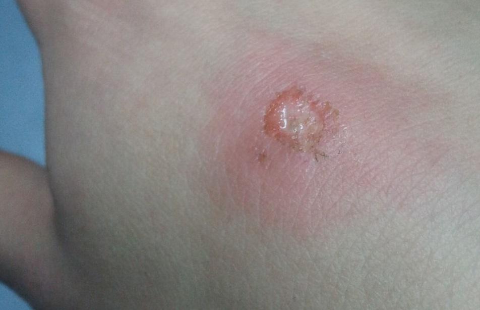 Так выглядит ожог от чеснока Так выглядит ожог от чеснока