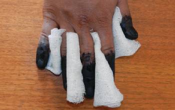 Ожог четвертой степени. Обугливание пальцев