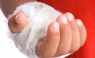 Ожог на пальце лопнул чем лечить