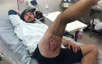 Ожог на бедре