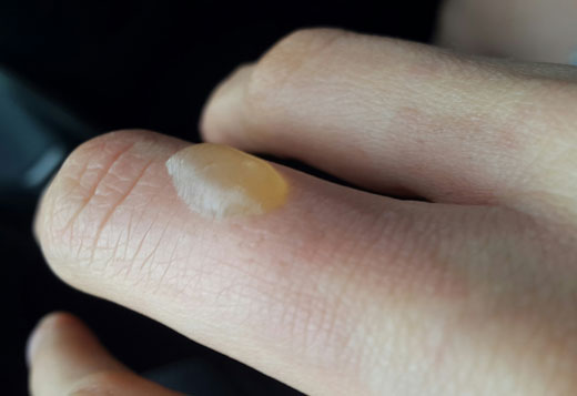 термический ожог на пальце руки