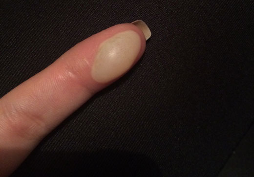 Ожог с волдырем на пальце