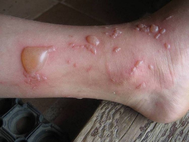 Как лечить ожог если появился волдырь