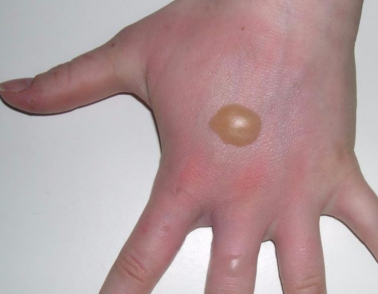 Как лечить ожог если появился волдырь