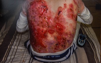 Ожог спины 3Б степени