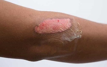 Ожог второй степени (Лопнувший волдырь на руке)