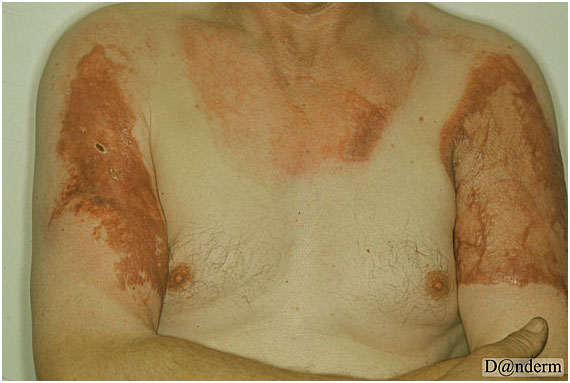 Рубцы на шее от ожога