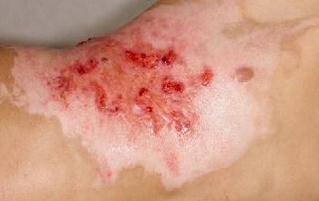 Процесс восстановления кожи