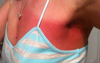 Результат лучевого ожога