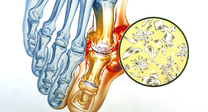 Подагра от чего возникает и как лечить