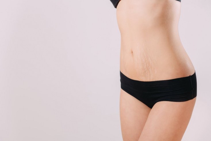 Растяжки после родов и тату Растяжки после родов и тату