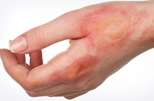 Средства от ожогов кипятком: лекарства, народные рецепты, лечение в домашних условиях