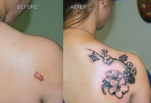 шрам до и после тату