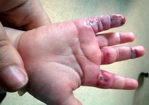 Чем мазать при ожоге утюгом в домашних условиях