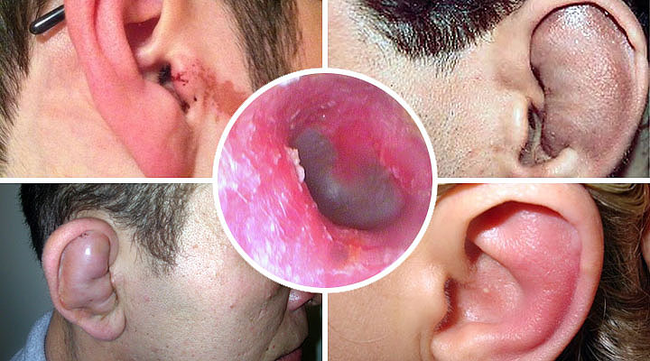 Наружный отит Наружный отит