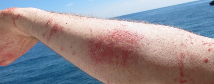 Краснота от ожога на руке Краснота от ожога на руке