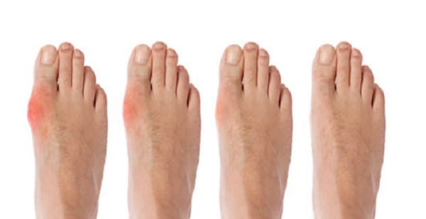 Уменьшение отека при подагре Уменьшение отека при подагре