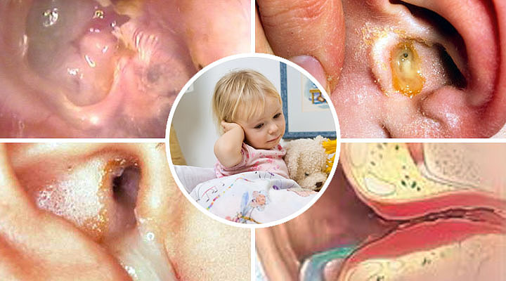 Виды патологии Средний отит