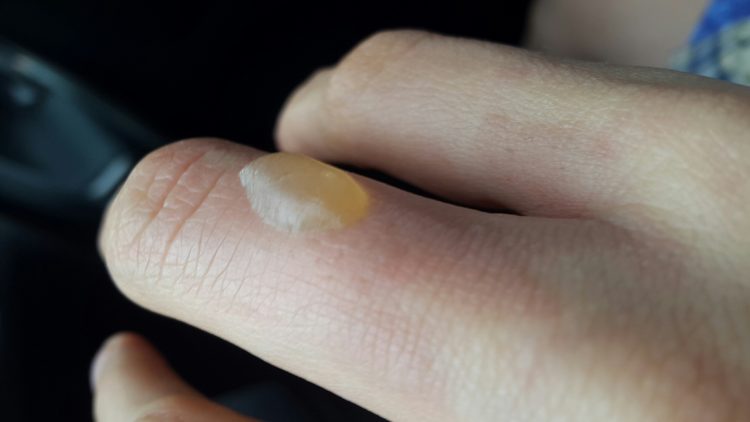 Как лечить ожог если появился волдырь